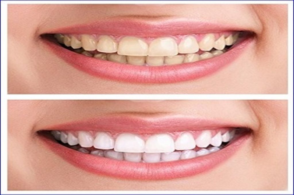 best charcoal teeth whitening