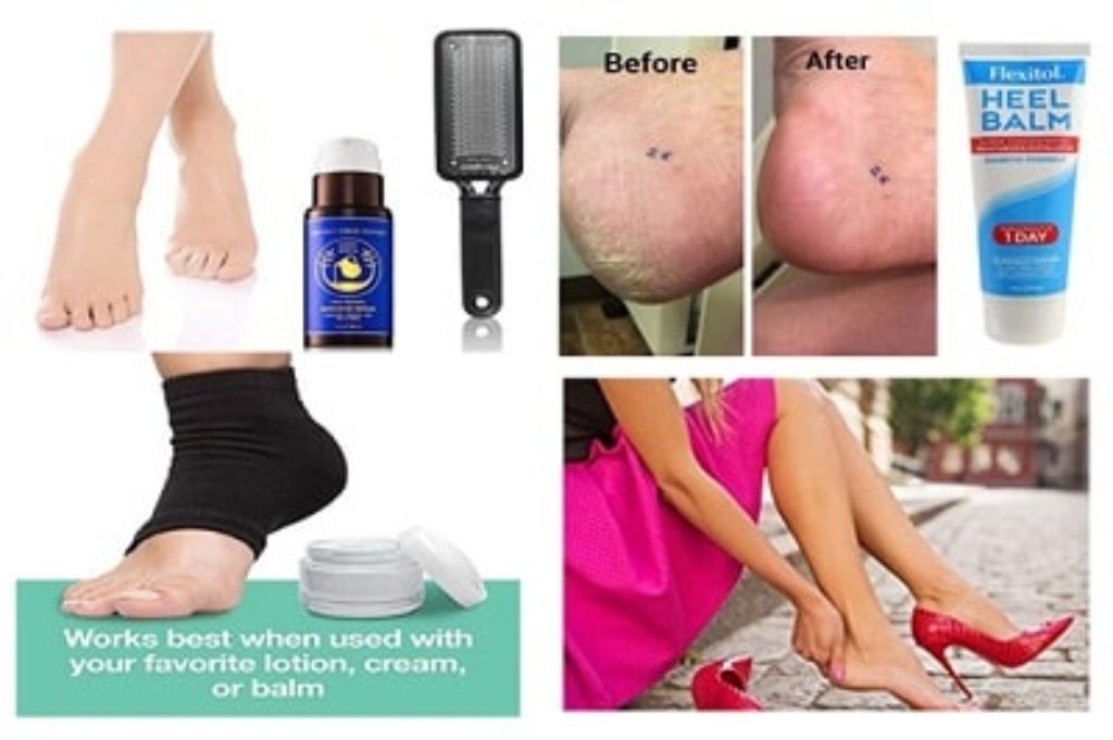 Best dry cracked heels treatment